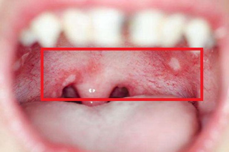 疱疹性口炎口腔白点图 疱疹性口炎口腔白点图