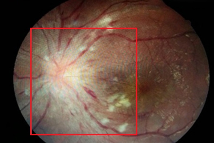 恶性高血压视网膜病变水肿图 恶性高血压视网膜病变水肿图
