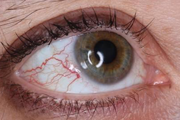 眼睛红血丝图