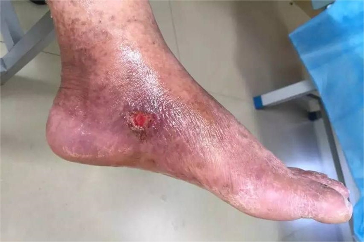 晚期糖尿病足湿性坏疽图 晚期糖尿病足湿性坏疽图