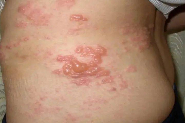 疱疹样天疱疮腰部小水疱图 疱疹样天疱疮腰部小水疱图