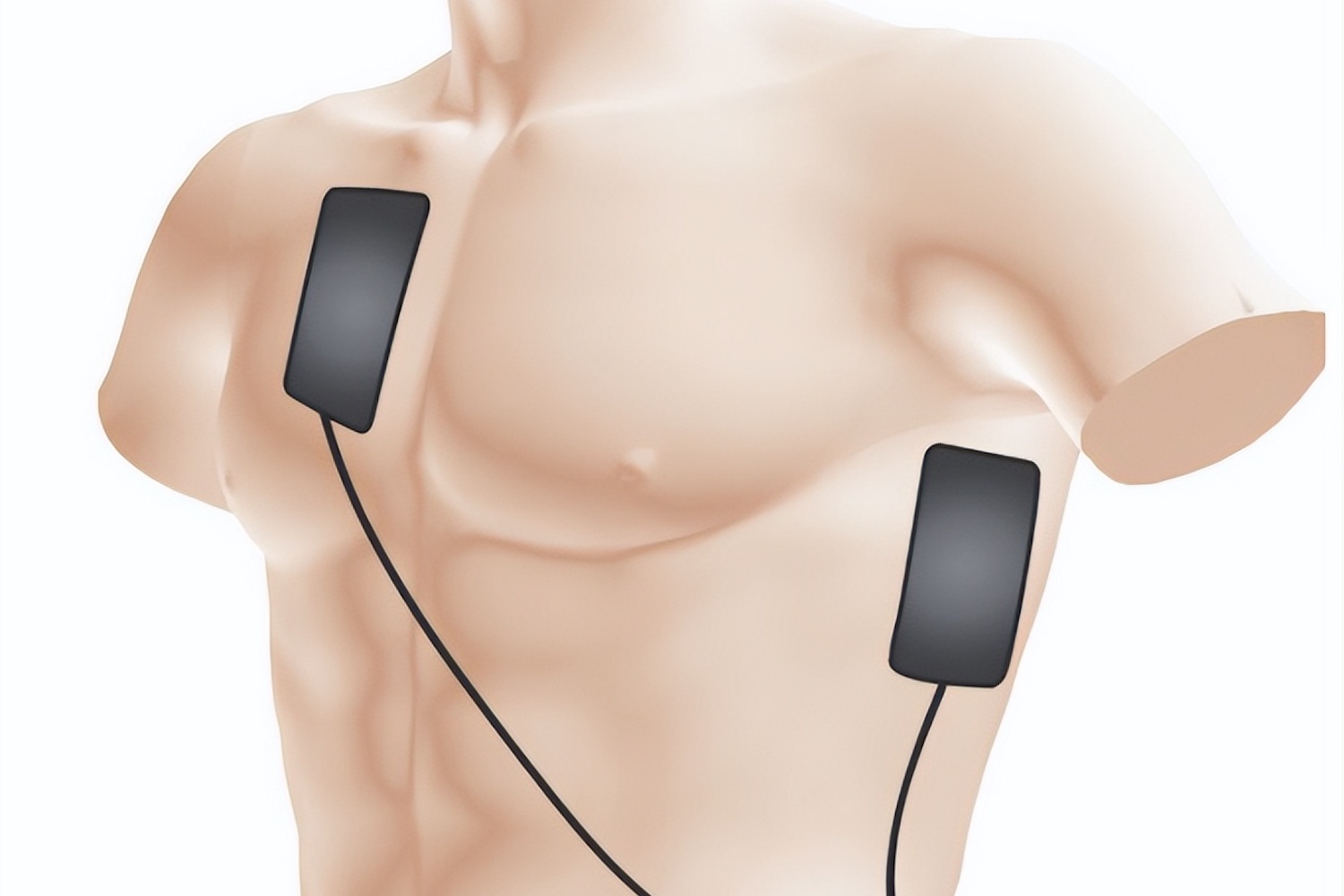 除颤仪胸部电极贴片位置图