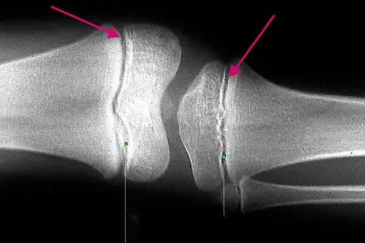 腿部骨骺线未闭合图