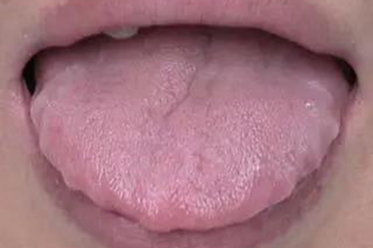 脾虚严重齿痕舌图