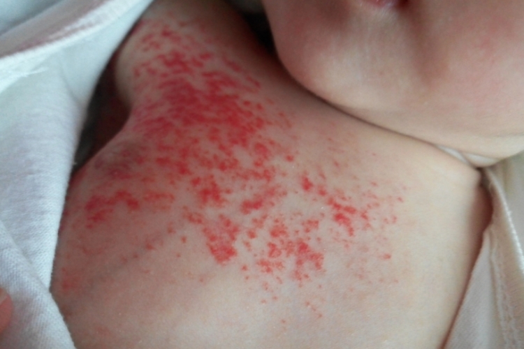 毛细血管瘤初期图