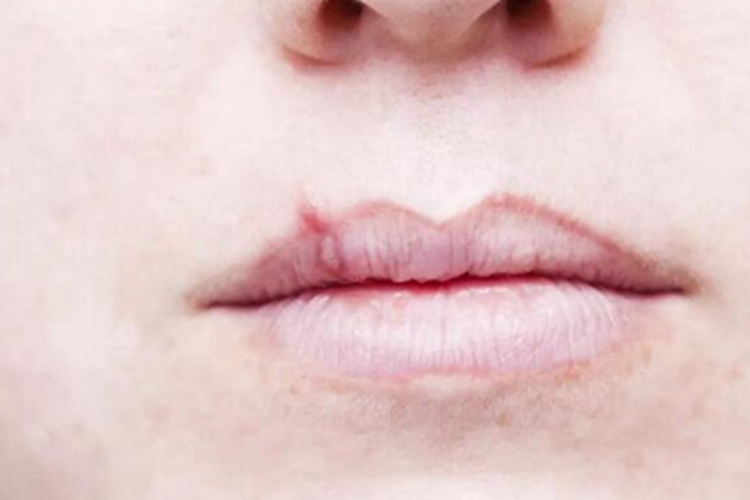 慢性苯中毒溃疡图