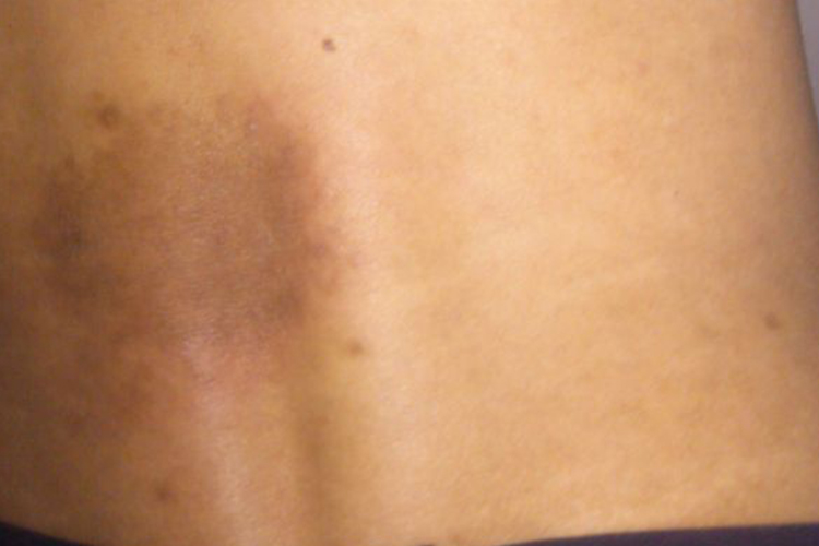 日晒伤后腰皮肤发黑图