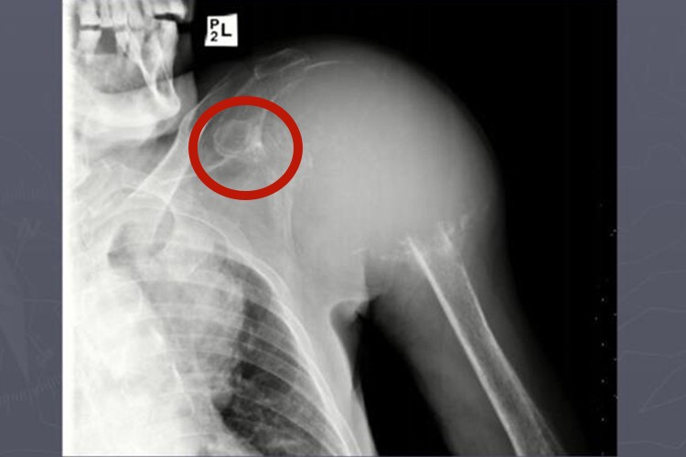 肩膀骨肉瘤图 肩膀骨肉瘤图