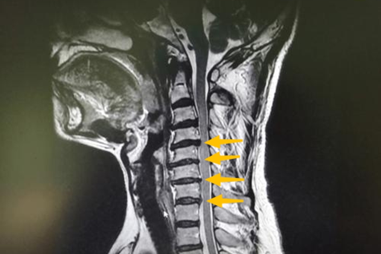 颈3-4-5-6-7椎间盘突出图