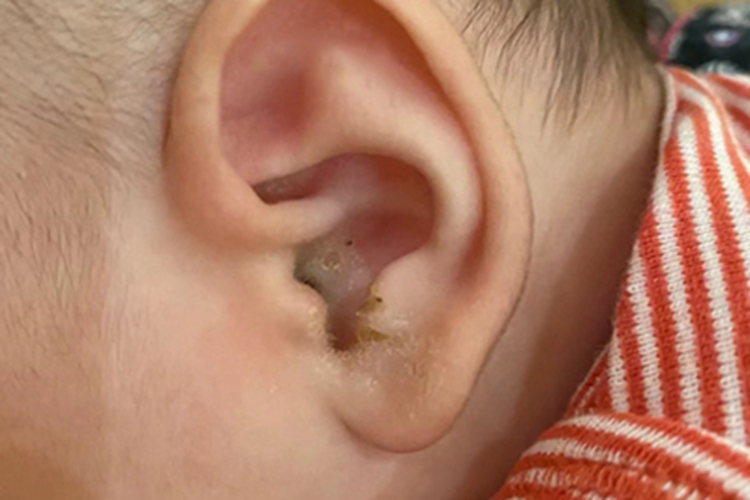 外耳湿疹耳朵上结黄痂图