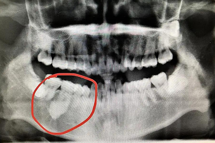 牙骨质瘤X片检查图
