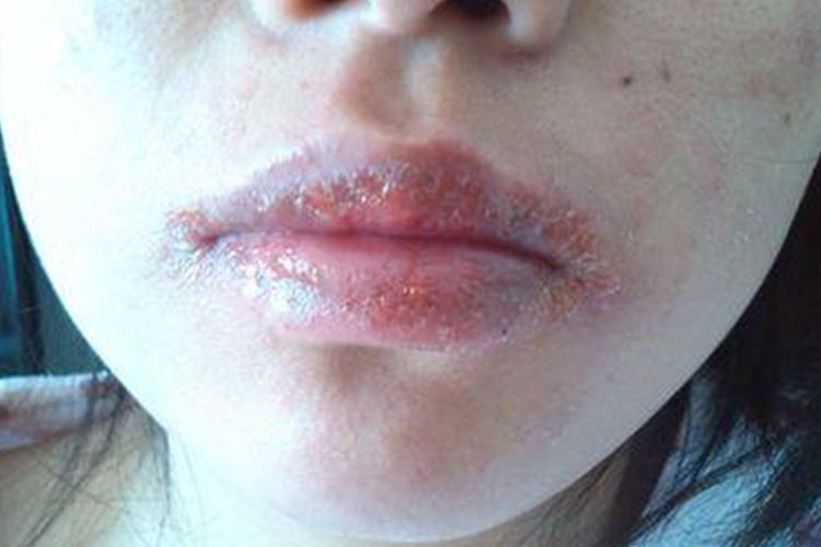 接触性唇炎嘴唇有结痂图