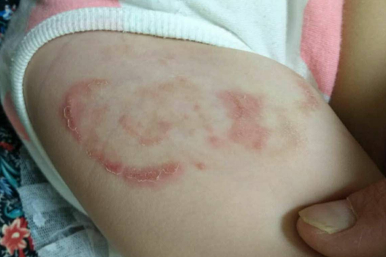 婴儿腿上长癣图