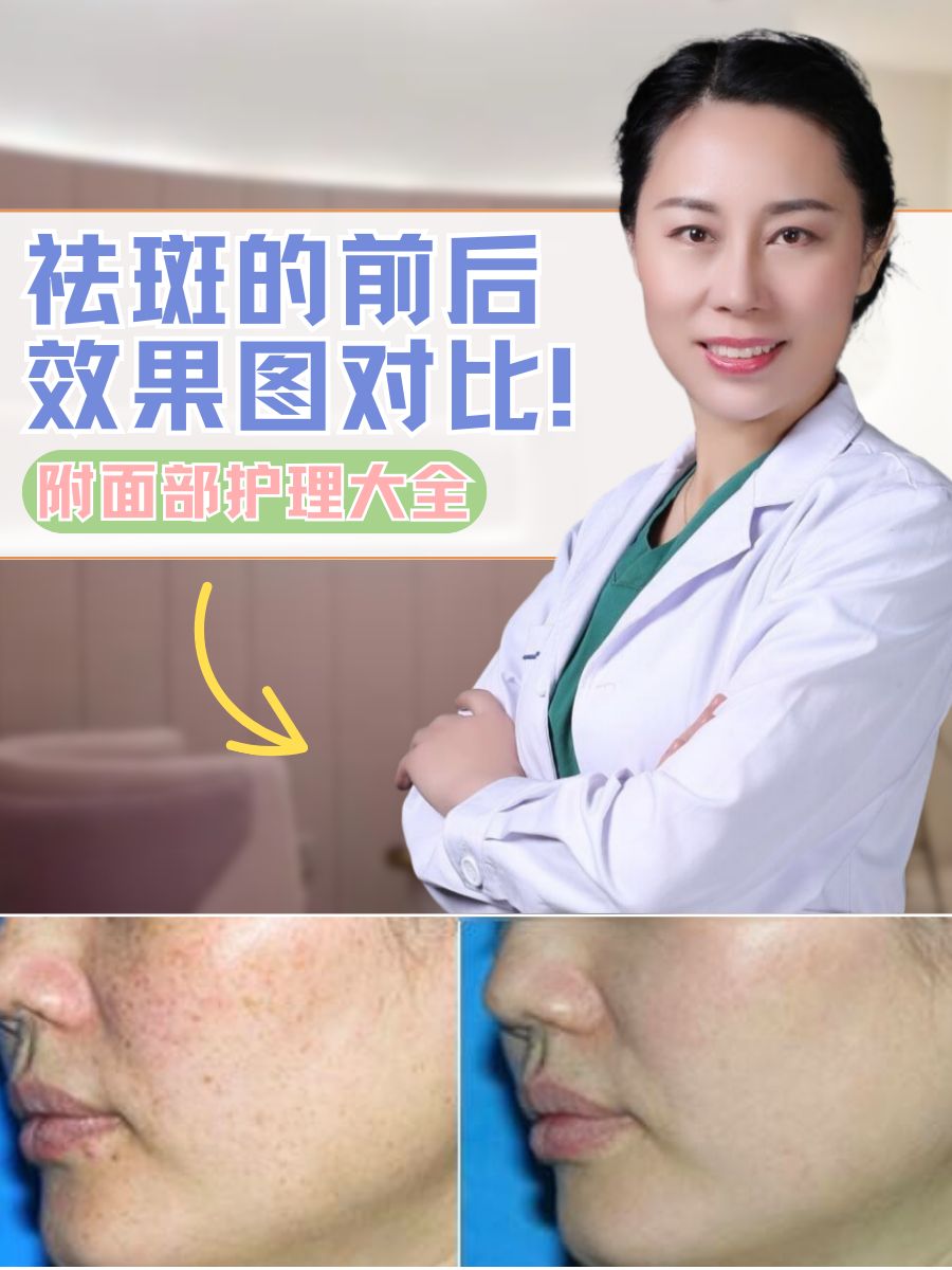 祛斑的前后效果图对比！附面部护理大全