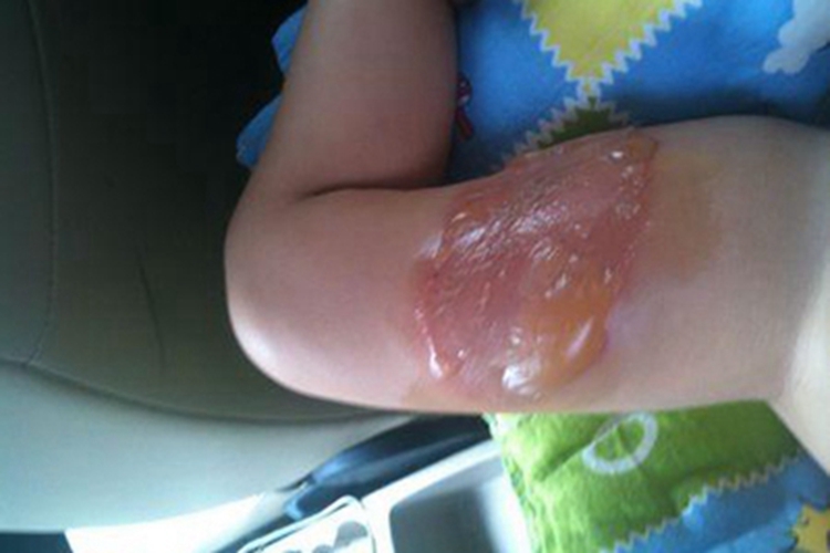 浅Ⅱ度烧伤大腿症状图 浅Ⅱ度烧伤大腿症状图