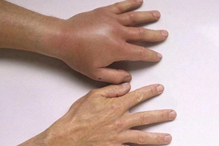 蜂蜇伤左手手背红肿图