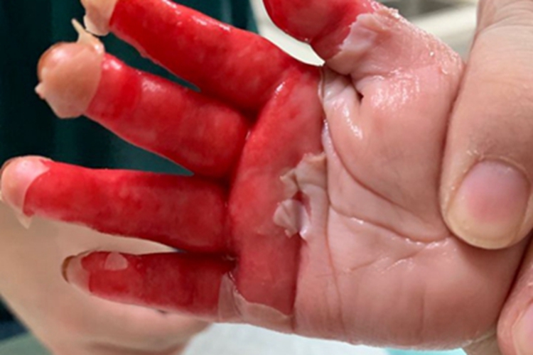 烫伤手指脱皮图