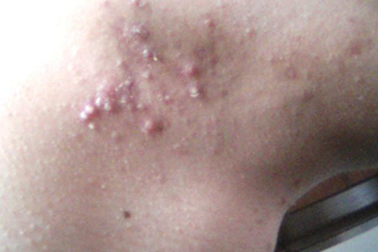 痤疮侧颈症状图