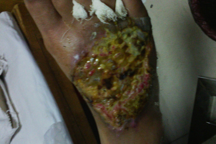 足部湿性坏疽图