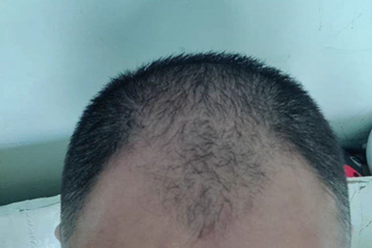 雄激素性脱发头上脱发图 雄激素性脱发头上脱发图
