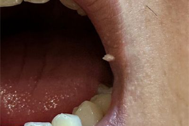 疣嘴唇症状图 疣嘴唇症状图