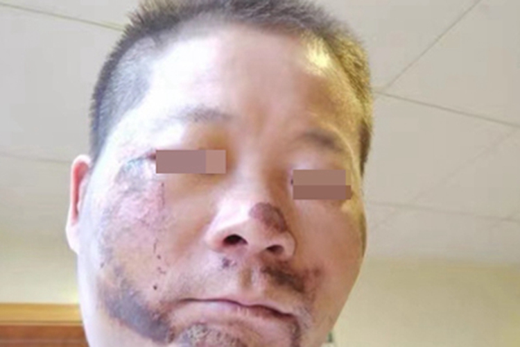 炎症后色素沉着面部斑图