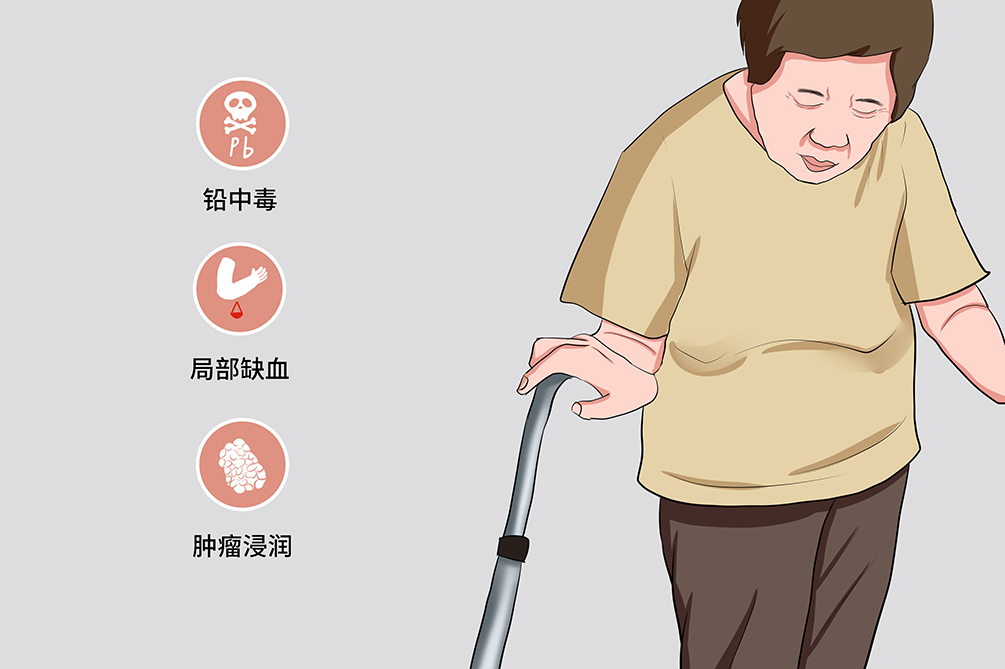 神经麻痹-有来医生