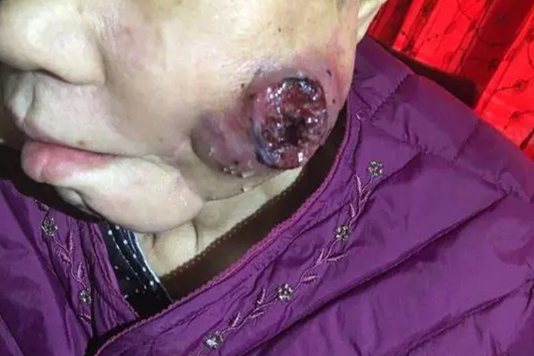 颊癌继发感染图