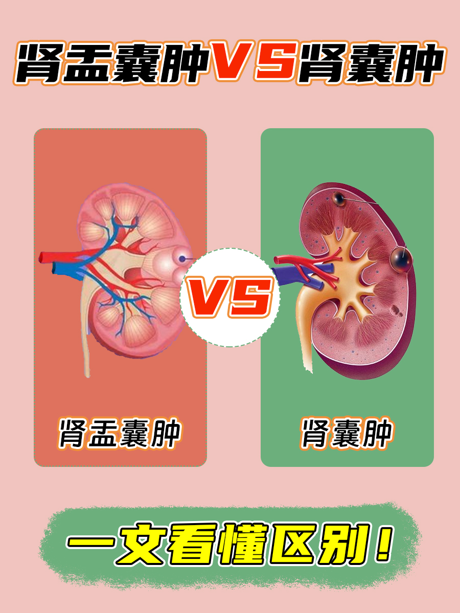 肾盂囊肿VS肾囊肿：一文看懂区别！