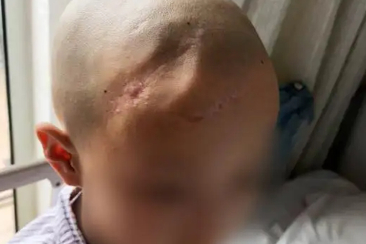 宝宝额头凹陷性骨折图