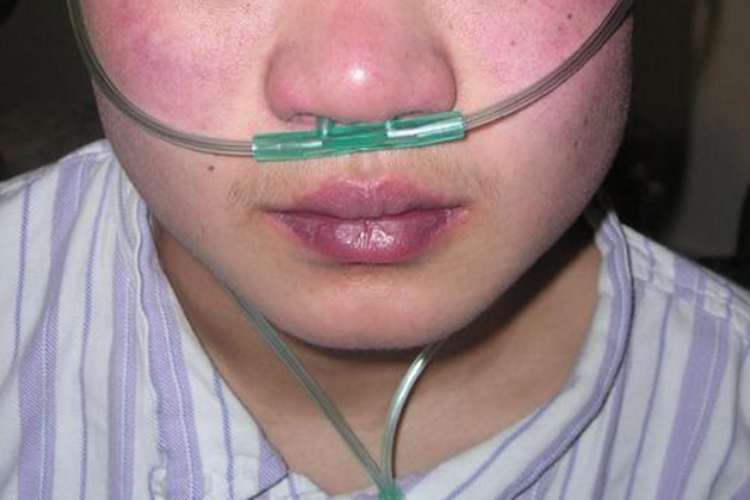 吃燕麦片过敏口唇青紫图 吃燕麦片过敏口唇青紫图