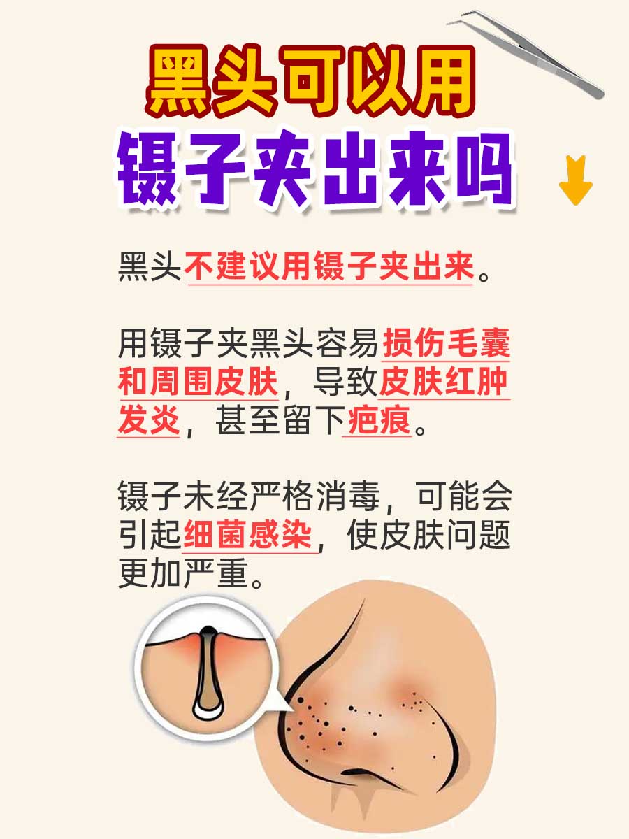 一文解析，黑头可以用镊子夹出来吗