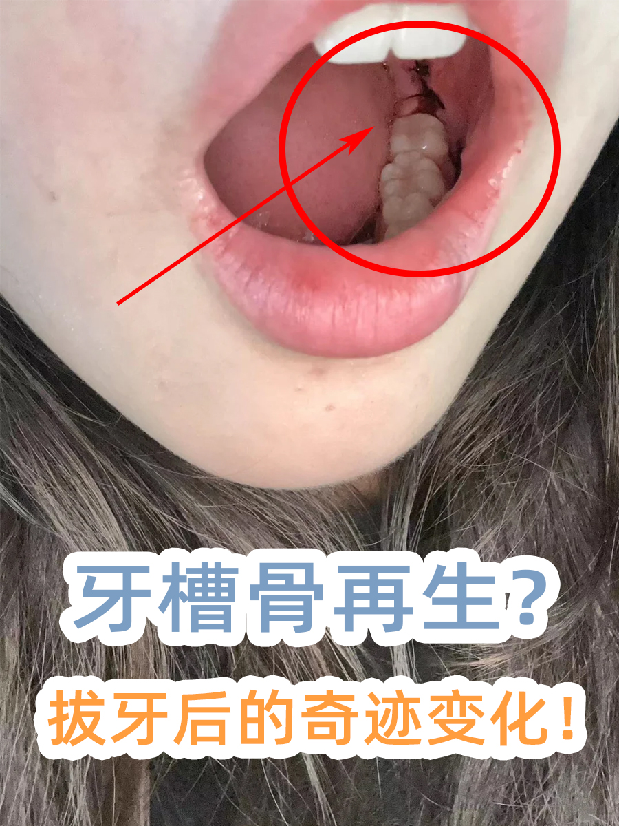 牙槽骨再生?拔牙后的奇迹变化!