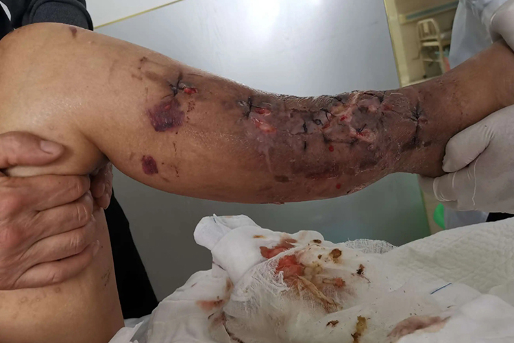 晚上腿摔伤骨折图 晚上腿摔伤骨折图