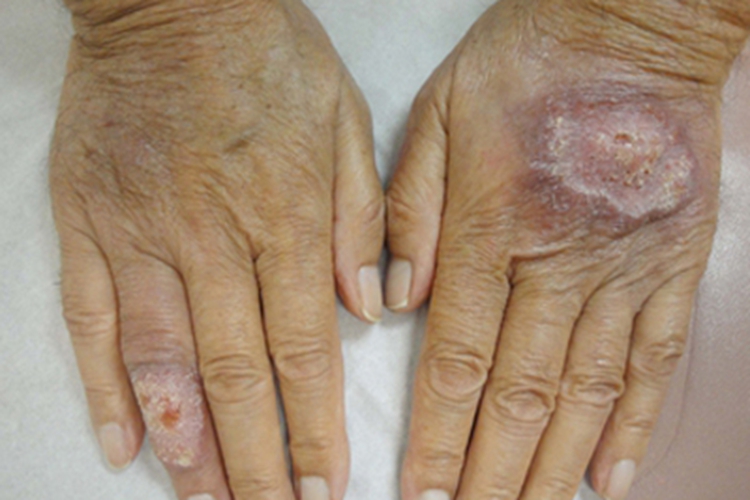 皮肤利什曼病发黑图