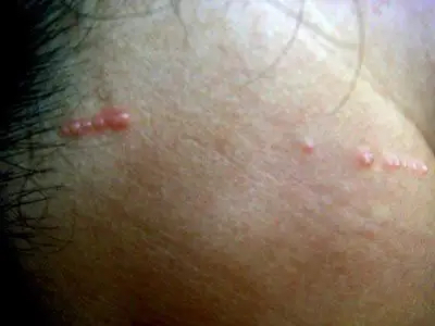 大腿根部传染性软疣图