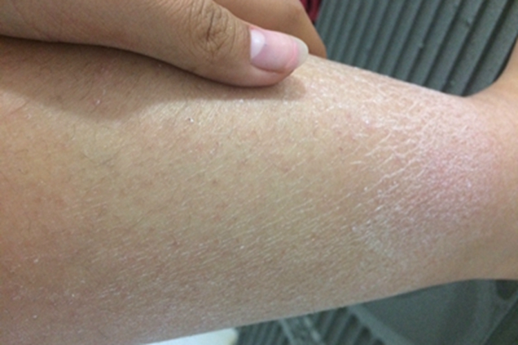 干燥综合征小腿症状脱皮图 干燥综合征小腿症状脱皮图