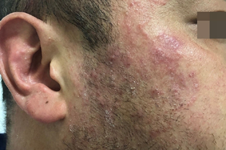 难辨认癣面部症状图