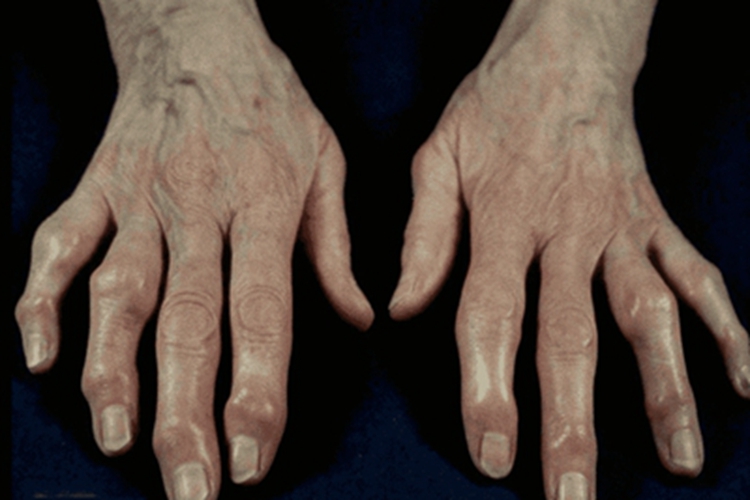 类风湿关节炎手指畸形图