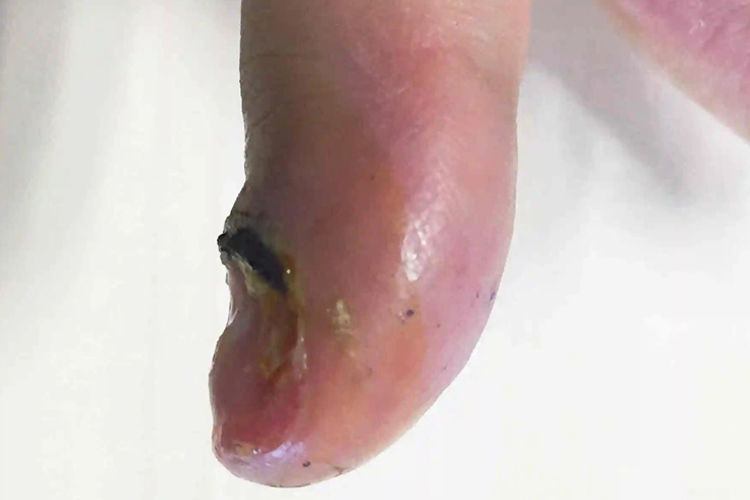 脓性指头炎图 脓性指头炎图