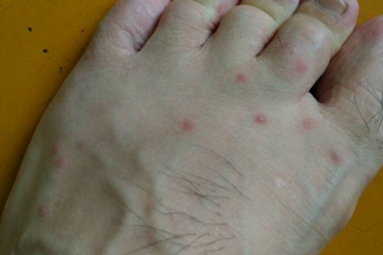 蚁蜇伤脚背小红疙瘩图 蚁蜇伤脚背小红疙瘩图