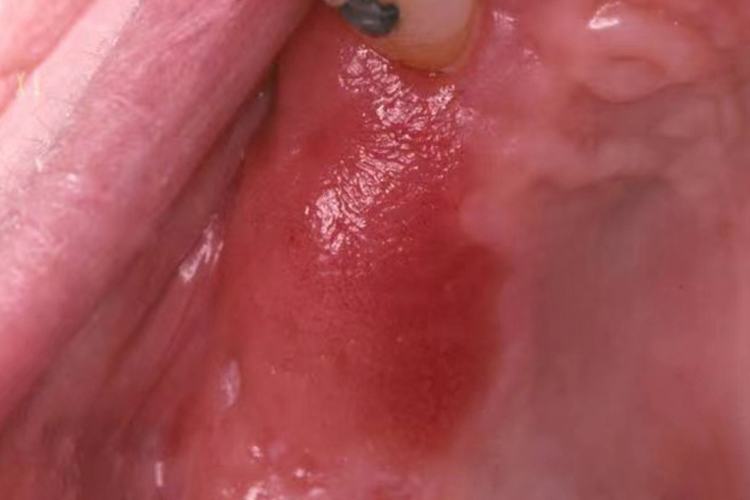 口腔红斑图