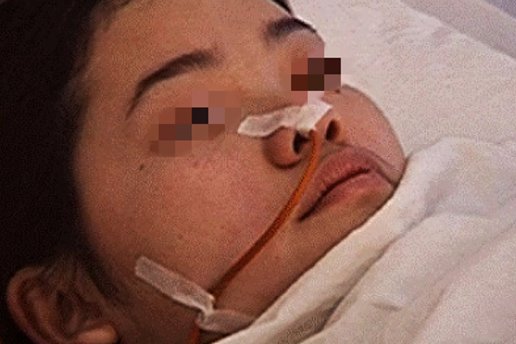 单侧鼻氧管固定完成图