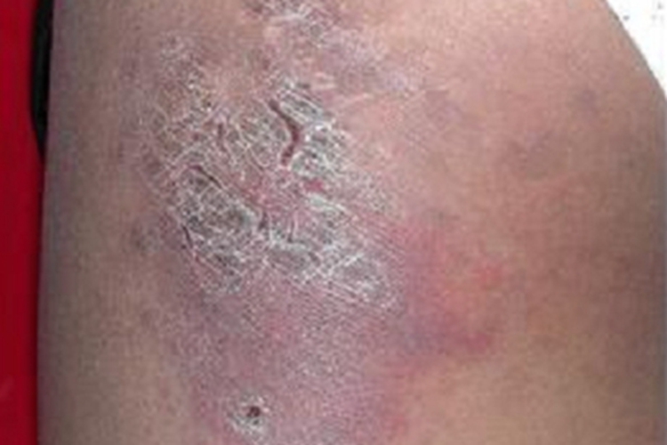 寒冷性脂膜炎腿症状图 寒冷性脂膜炎腿症状图