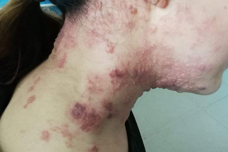 脖子侧面带状疱疹图 脖子侧面带状疱疹图