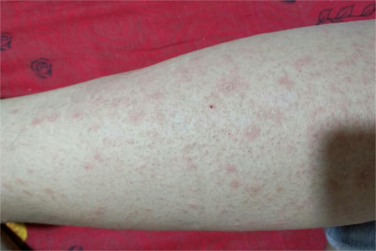 艾滋病期腿上红点图