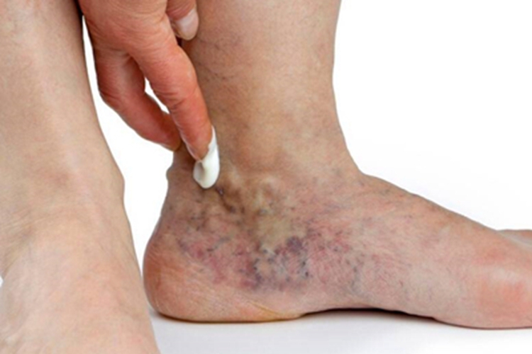 下肢静脉曲张脚踝肿胀发紫图