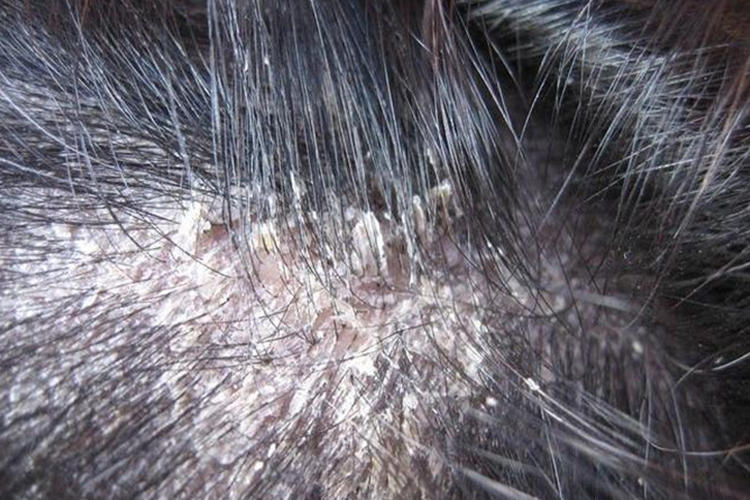 头部脂溢性皮炎图