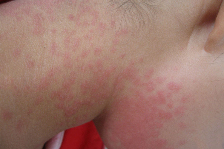 螨虫过敏颈部丘疹图 螨虫过敏颈部丘疹图
