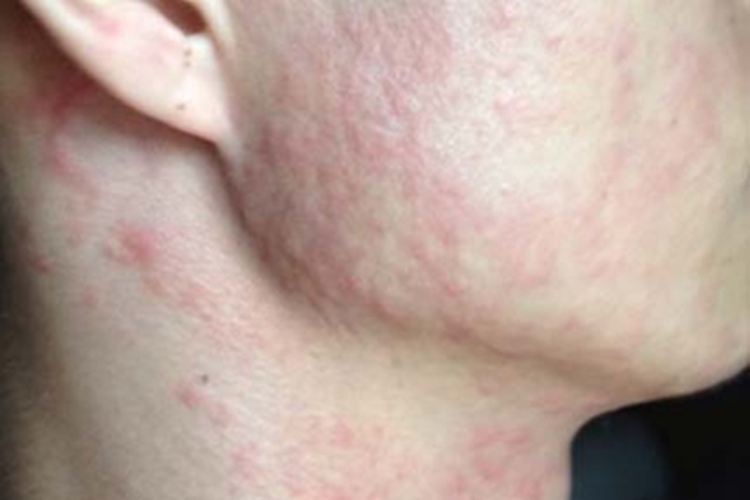 神经性皮炎面部症状图